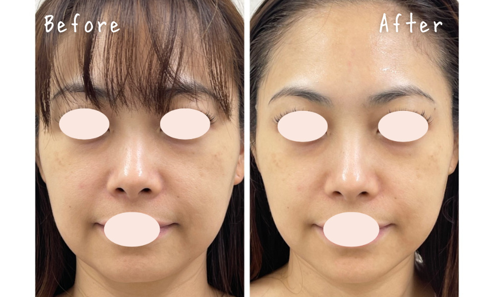 ダイヤモンド美顔器 ダイヤモンドチップによるたるみ改善効果 - BLAZE CLINIC │ 沖縄県